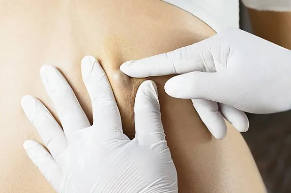 Kist ve Lipom Alımı